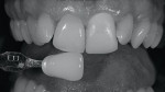 Figure 3  With one good value image, with photo-editing software one can gather much more information. One can now check the value by converting to black and white, contrast the teeth to bring out the color to see what ceramic effects can be layered