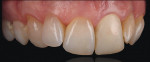 Figure 6  Images shot with the paper diffuser technique. The colors in the dentition b.come more apparent against a black contrast.