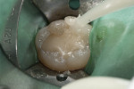 Fig. 4. High-viscosity glass restorative (EQUIA Fil) was mixed and injected directly into cavity using bulk-fill technique and allowed to set for 2 minutes and 30 seconds.