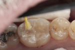 Fig. 5. After occlusal equilibration, light-cured resin (EQUIA Coat) was applied and light-cured for 20 seconds.