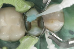 Fig. 11. Polyacrylic acid was applied to clean and condition the cavity.