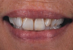 Figure 14  The case at 6 months blends harmoniously with the surrounding dentition.
