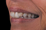 Figure 15  The case at 6 months blends harmoniously with the surrounding dentition.