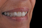 Figure 16  The case at 6 months blends harmoniously with the surrounding dentition.