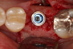 Fig. 8. A 5 mm x 11.5 mm implant was placed into the osteotomy created at the center of the previously grafted socket.