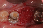 Fig. 14. The extraction socket was filled to the crest with mineralized cancellous allograft bone with a particle size of 0.25 mm to 1 mm that was hydrated with L-PRF.