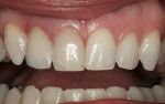 Figure 9  Permanent cementation of the e.max crown on tooth No. 7 fabricated with E4D Dentist.