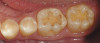 Figure 3  There is a mesial inclination of the maxillary teeth from gingival to occlusal in the esthetic dentition. Maxillary posterior teeth have an axial inclination which converges from the gingival through the occlusal toward a central fulcrum.