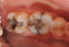 Figure 1   Classic presentation of the bruxism triad. Lateral wear pattern, generalized buccal tooth loss from erosion and abrasion, and history of sleep disruption.