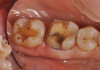 Figure 2   Asymmetric tooth wear in a bruxism triad patient as a result of friction from bruxing, poor salivary lubrication as a byproduct of medication, and roughened surfaces created as a result of erosive reflux.
