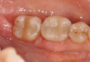 Figure 3   In addition to the traditional sleep apnea risk factors (over 40 years old, male, overweight, >17 inch neck size), practitioners should add the tooth wear and erosion components of the bruxism triad.