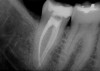 Figure 12  Childhood presentation of the bruxism triad. Patient had erosive and attritional wear on deciduous teeth, constricted dental arches, and deep class II bite. Physician examination revealed significant GERD paired with enlarged adenoids and tonsils.
