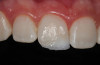 Figure 21   Mature patient with the bruxism triad. Lifetime history of bruxism, snoring, intermittent poor sleep, and GERD symptoms. Sleep study results indicate severe apnea.