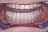 Figure 5  The space between the rubber dam clamp and the tooth should be sealed with a caulking material of choice. Once final isolation is obtained, the integrity of the fluid-tight seal should be checked by flooding and submerging the isolated tooth with sodium-hypochlorite solution. If the patient cannot taste the bleach material, a proper seal has been achieved.