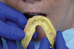 Fig 3. Housings are removed from the prosthesis and a closed-mouth reline procedure is completed.