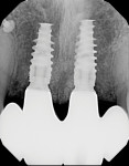 Posttreatment periapical radiograph of the final restoration in place. Note the ideal emergence and bone levels.