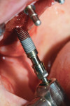 A 4.3 mm x 13 mm implant being placed. Note the hydrophilicity exhibited by its surface.