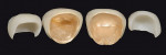 Figure 3  Bench-top view of final restorations showing metal to the edge on Captek Nano crowns for teeth Nos. 8 and 9.