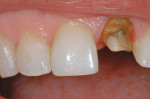 Figure 6  Deep shoulder preparation on discolored non-vital tooth No. 9.