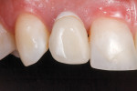 Fig 12. Patient presented with a 3-year-old implant restoration in place at the lateral incisor position with esthetically problematic recession. A connective tissue graft had been performed 1 year prior to this visit. Clinical evaluation revealed an implant that was angled facially and an abutment that was significantly overcontoured mesiodistally and coronally. It was hypothesized that this overcontour was the cause of the recession and an undercontoured emergence zone may correct it.