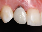 Fig 13. Composite/titanium provisional in place on the implant. The undercontoured facial surface was evident by the exposure of the Ti abutment itself. This was an extreme example of undercontouring due to the severe angle and limited depth of the implant.
