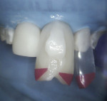Fig 6. Intraoral photograph of tooth No. 9 after injection overmolding with heated composite using the Bioclear method.
Tooth No. 8 was injection overmolded and polished to 80% completion. Bioclear Black Triangle Large Pink matrices are forming an aquarium on tooth No. 9 and a shield on tooth No. 10.