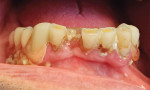 Fig 1. The patient presented after a 7-year absence from the practice with a flexible nylon lower partial denture, fractured tooth No. 25, caries on the adjacent anterior teeth, and heavy accumulation of plaque and food on the teeth and prosthesis.