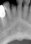 Fig 2. Radiograph showed tooth No. 25 was fractured at the gingiva with periapical pathology and interproximal decay noted on the adjacent incisors.