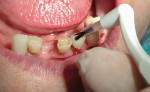Fig 6. After the teeth to be restored with bonded resin restorations were acid-etched, rinsed, and dried, DiaPlus bonding agent was applied to all surfaces, including all unaffected enamel of the teeth being restored, to seal them and help prevent future caries due to the patient’s limited homecare. The bonding agent was air-thinned to remove the ethanol carrier and light-cured for 20 seconds.
