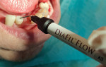 Fig 7. The incisal preparations were filled with DiaFil Flow flowable composite to the level of the facial and lingual enamel surfaces and light-cured. DiaFil Flow provides good flow and adaption to the preparation with minimal polymerization shrinkage, excellent fracture toughness, and high tensile and compressive strengths that aids in preventing further incisal wear during normal functioning.