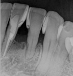 Fig 5. Radiograph post–orthodontic treatment.