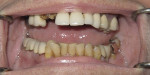 Figure 1  Patient presented with multiple missing teeth and remaining teeth with a poor prognosis.