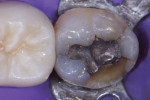 Pretreatment view of a molar with a failed Class I amalgam restoration and a fractured distolingual cusp. Note the isthmus width greater than 2 mm and the presence of a mesial marginal ridge (ie, peripheral rim) fracture.