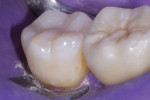 The final restoration was shaped and polished with carbide burs and composite polishers (H48LQ.FG.012, H379Q.FG.018, and 9525UF.RA.085; Komet USA). The primary anatomy provides function, while the smooth surfaces reduce biofilm accumulation.