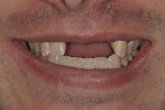 Figure 6  The full smile revealing a low-to-medium lip line.