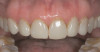 Figure  7  A temporary from another patient demonstrating the small amount of gingival flash that is routinely created with this technique.