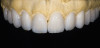 Figure 12  A tooth from an extra denture set that fits the space can be molded into position by using red rope wax.