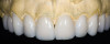 Figure  14   A tooth from an extra denture set that fits the space can be molded into position by using red rope wax.