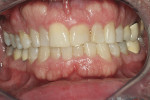 Figure 1  Preoperative view of the patient showing 20-year-old laminate veneers.