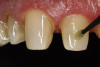 Figure 21  The mock-up is impressed,removed, loaded with bis-acryl, and re-inserted over the prepared teeth to create a provisional that needs little contouring and finishing.
