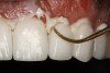 Figure 23  After application of the glaze, the temporary is inserted with temporary cement, the excess removed, and the occlusion is verified.