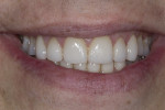 Fig 13. Patient’s smile, post-treatment.