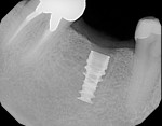 Figure 10  Radiographic confirmation of placement as planned.