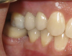 Figure 6 Intraoral photograph taken immediately after cementation of the crown.