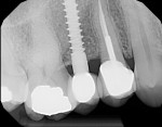 Figure 7  After 2 years, a radiograph showed better dense bone at the crestal level, as well as growth of bone over the collar level.