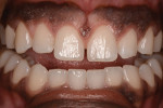 Fig 15. At 3-month postoperative follow-up after second ECL procedure, the gingival margin was at the CEJs of teeth Nos. 6 through 11.