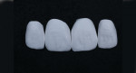 Fig 5. The final crowns post-milling. Digitally designed surface characterizations are executed during the CAM process.