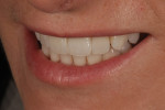 Fig 13. The patient’s smile 2 weeks after insertion.