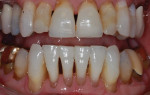 Initial exam retracted photograph with teeth apart highlighting the acceptable maxillary occlusal plane with the exception of teeth Nos. 7 and 10 (which are too short), the discrepancy in the mandibular occlusal plane, the attrition on the mandibular incisors, and the uneven length of the maxillary incisors.