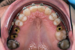 Fig 5. Occlusal view after implant placement.